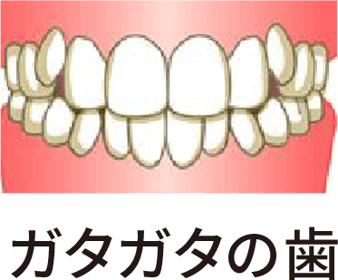 ガタガタの歯